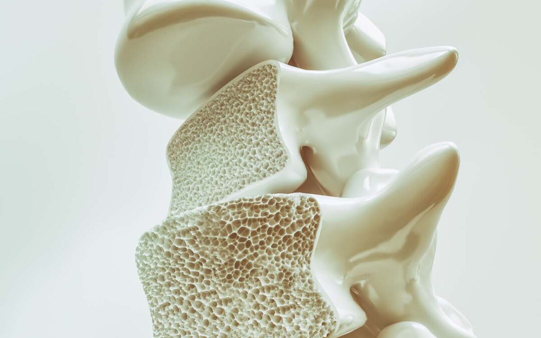 Neue Erkenntnisse im Kampf gegen Osteoporose