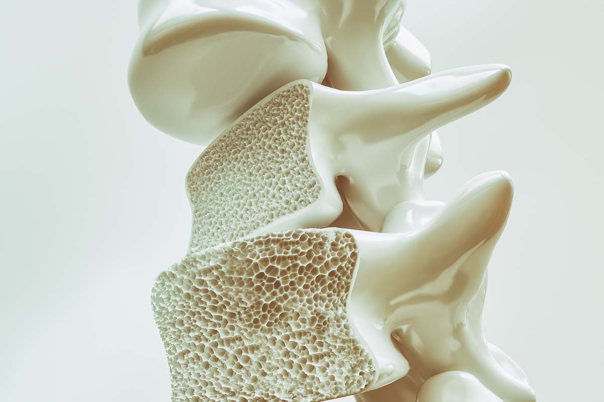 Osteoporose in der Wirbelsäule