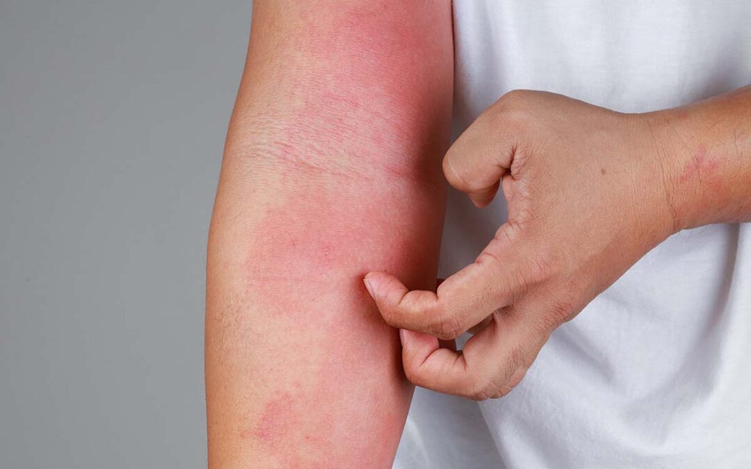 Verbindung zwischen Hautflora und Strahlen-Dermatitis entdeckt