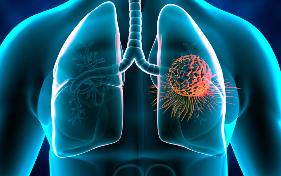 Früherkennung von Metastasen durch innovative Lungenanalyse