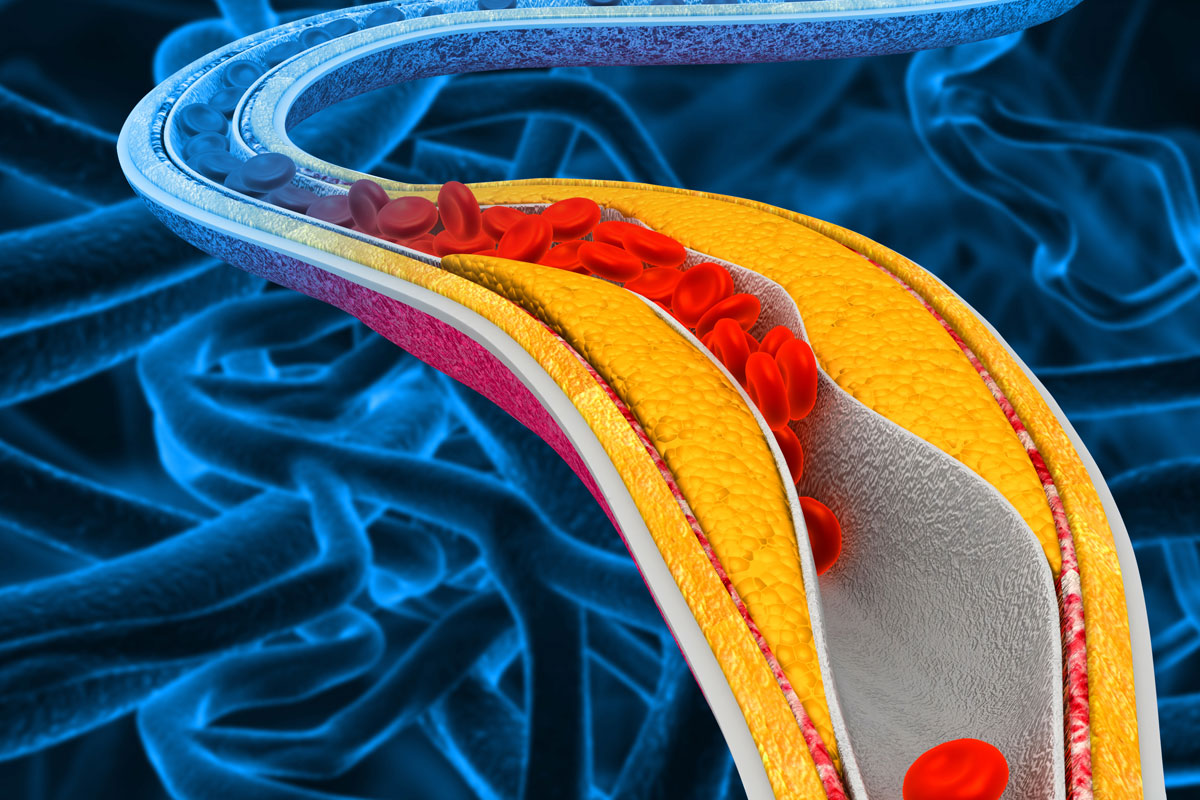 Abbildung einer Cholesterin blockierten Arterie