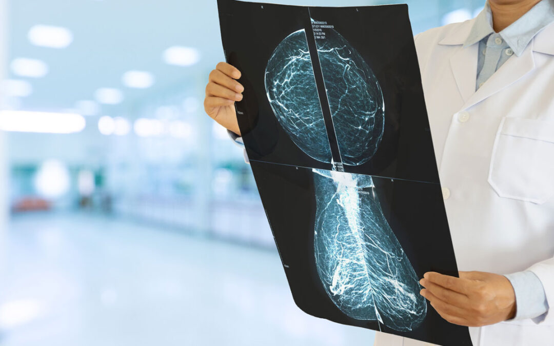 KI in der Mammographie ermöglicht präzisere Krebserkennung