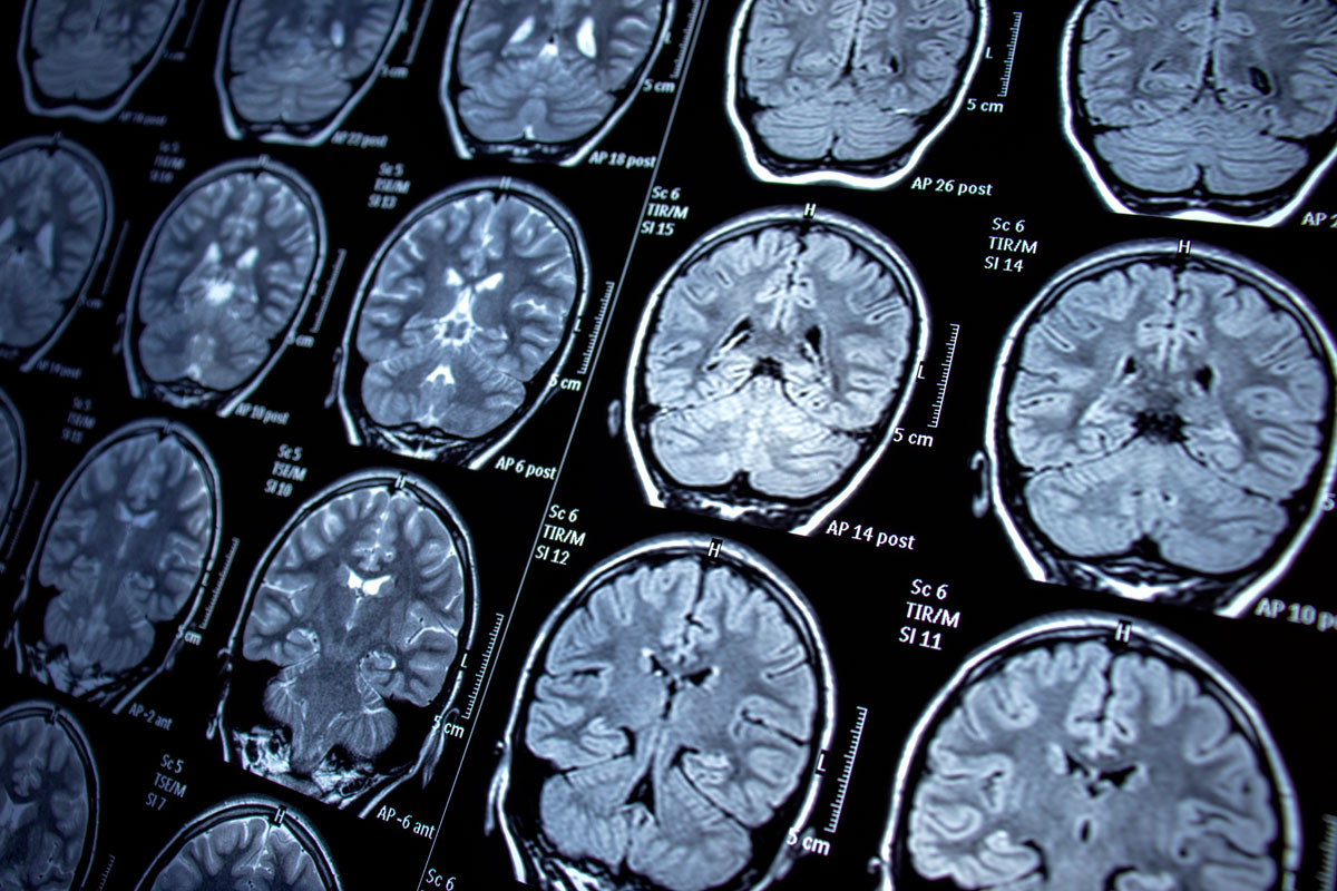 MRT-Aufnahme für Erkennung neurologischer Erkrankungen