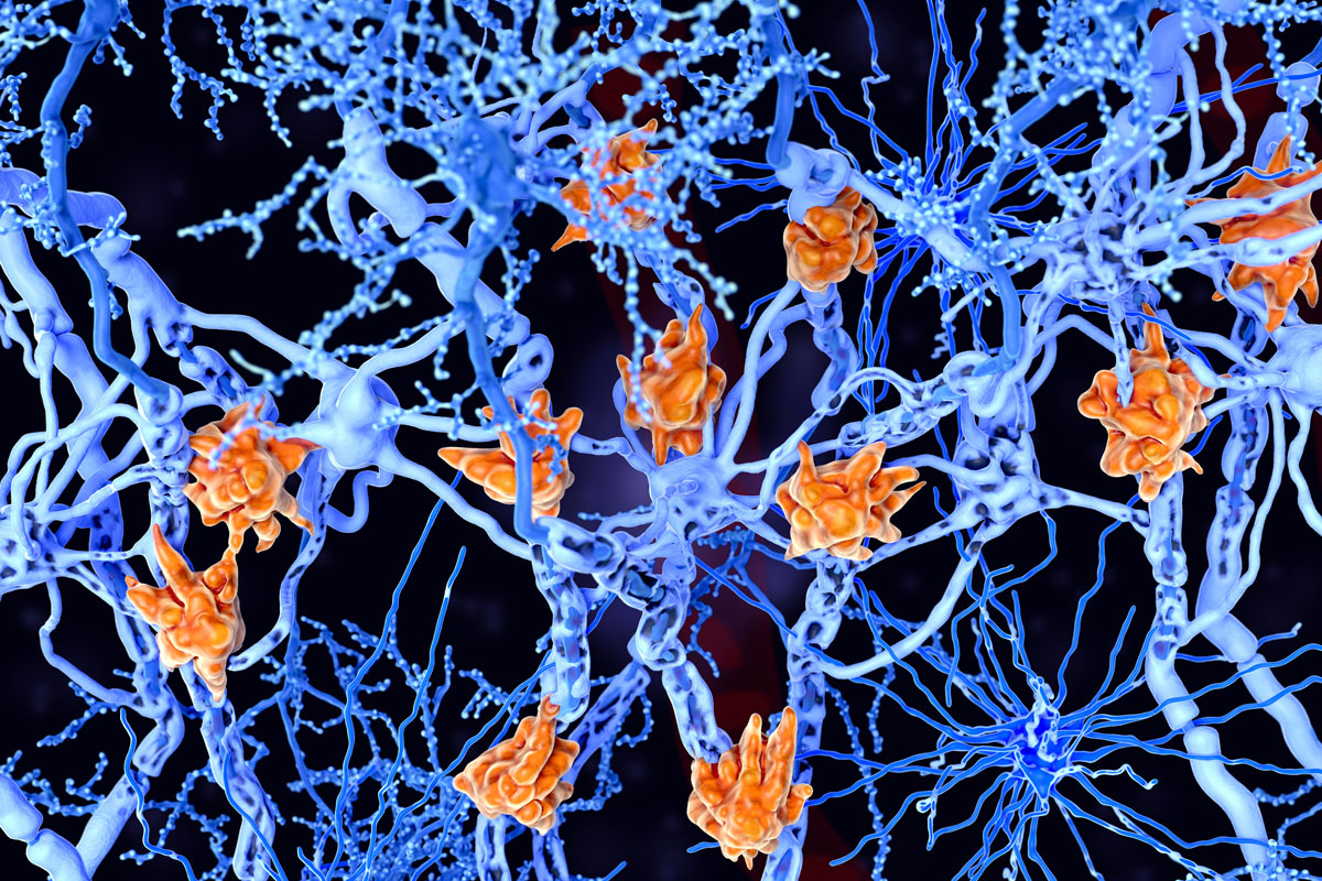 Mikroglienzellen schädigen die Myelin-Hülle von Neuronenaxonen